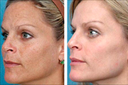 Химичческий пилинг лица: фото до и после процедуры